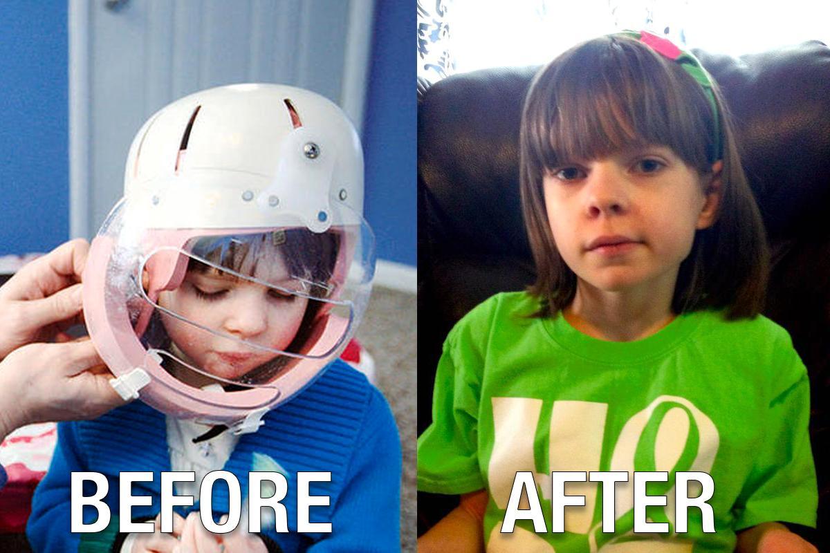 Medical Marijuana Saved This Girl From Having 30-80 Seizures A Day